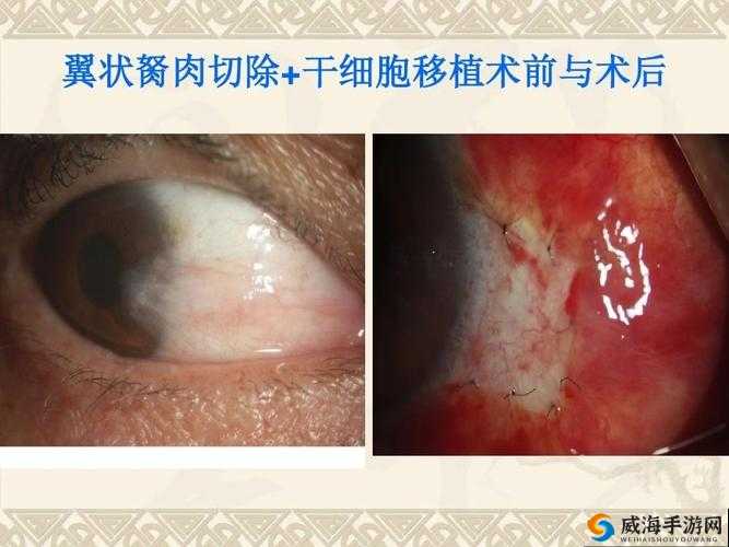 超级胬肉系统的创新应用与发展