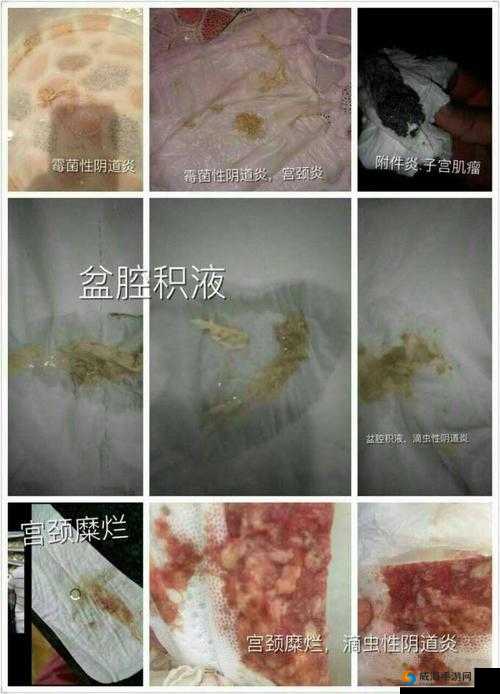 老中医李雪妮排阴蝳：真的有效吗？
