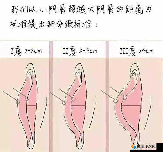 小阴天唇肥大整形：必要性探讨