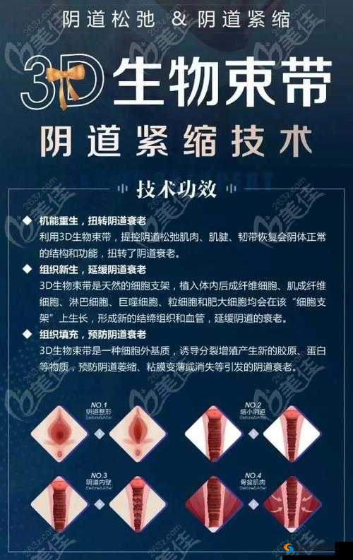 3d 生物束带紧缩术维持时间:几年?
