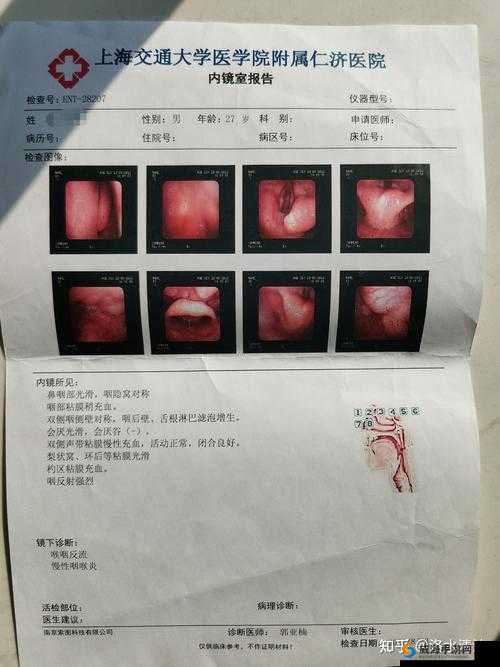 医院计划喉炎什么症状？详细症状介绍