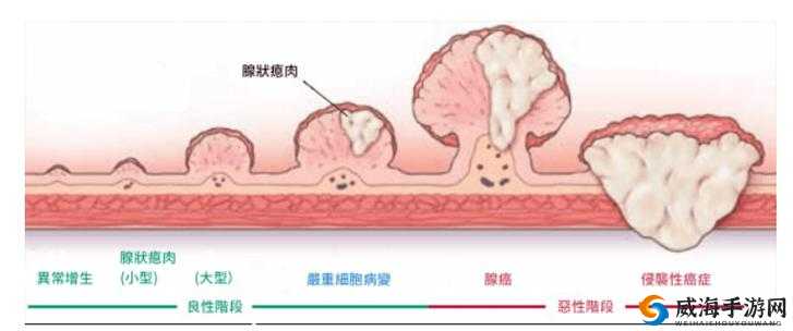 肛門ポリープ 是什么意思:肛门息肉