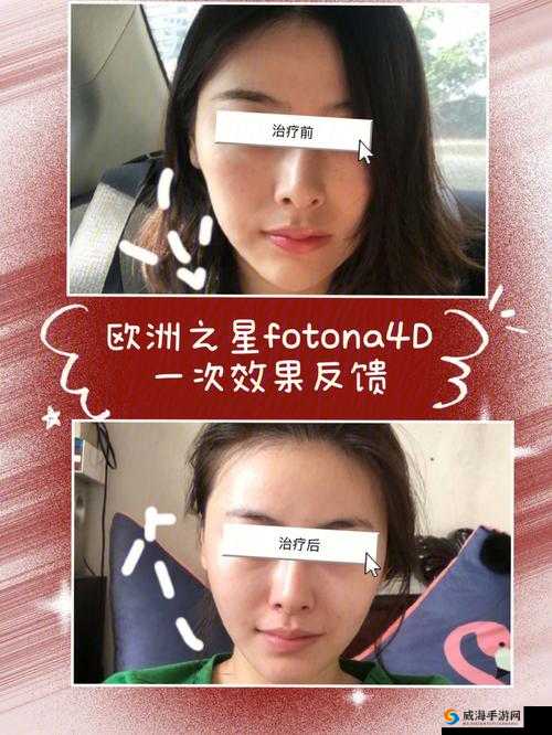 欧洲之星 4D 做一次效果怎么样:提升肌肤年轻态