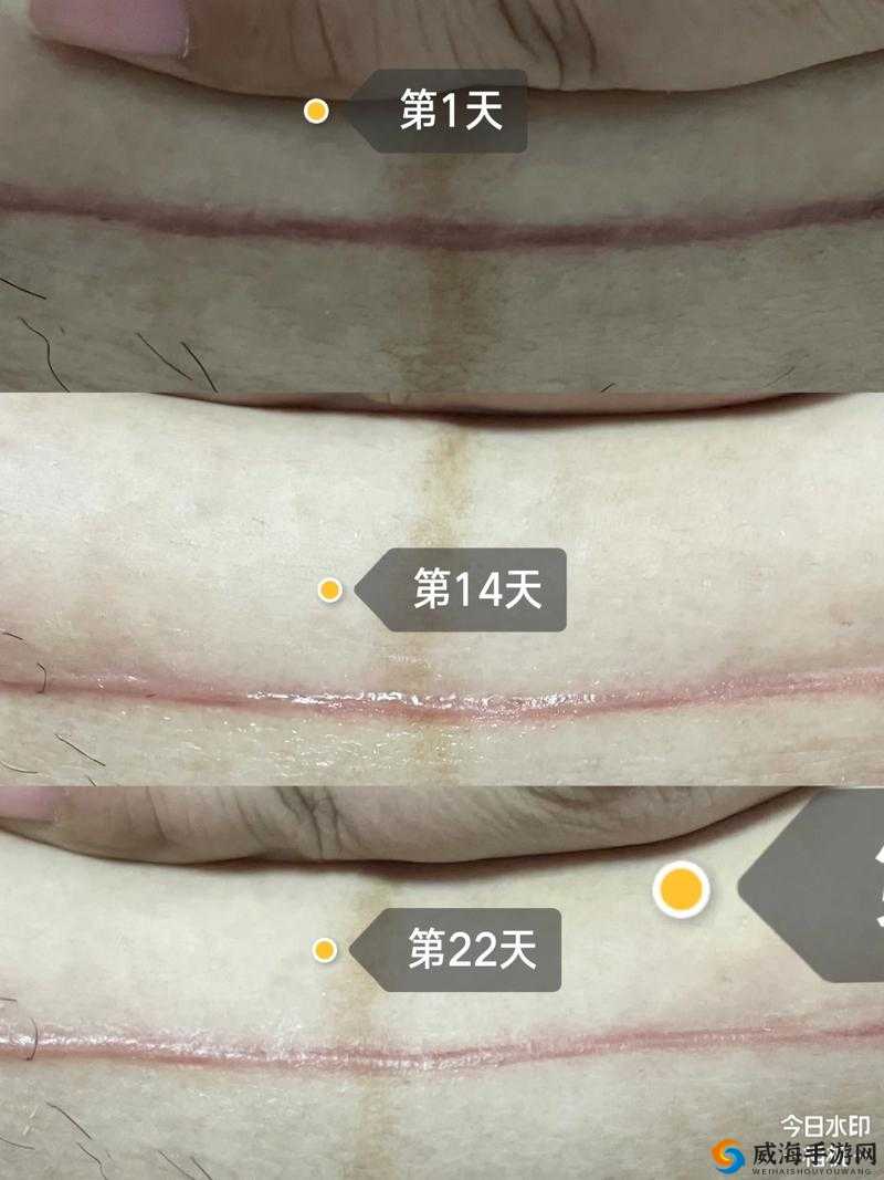 女生做完下面疼几天能恢复:不同情况下的具体时长分析