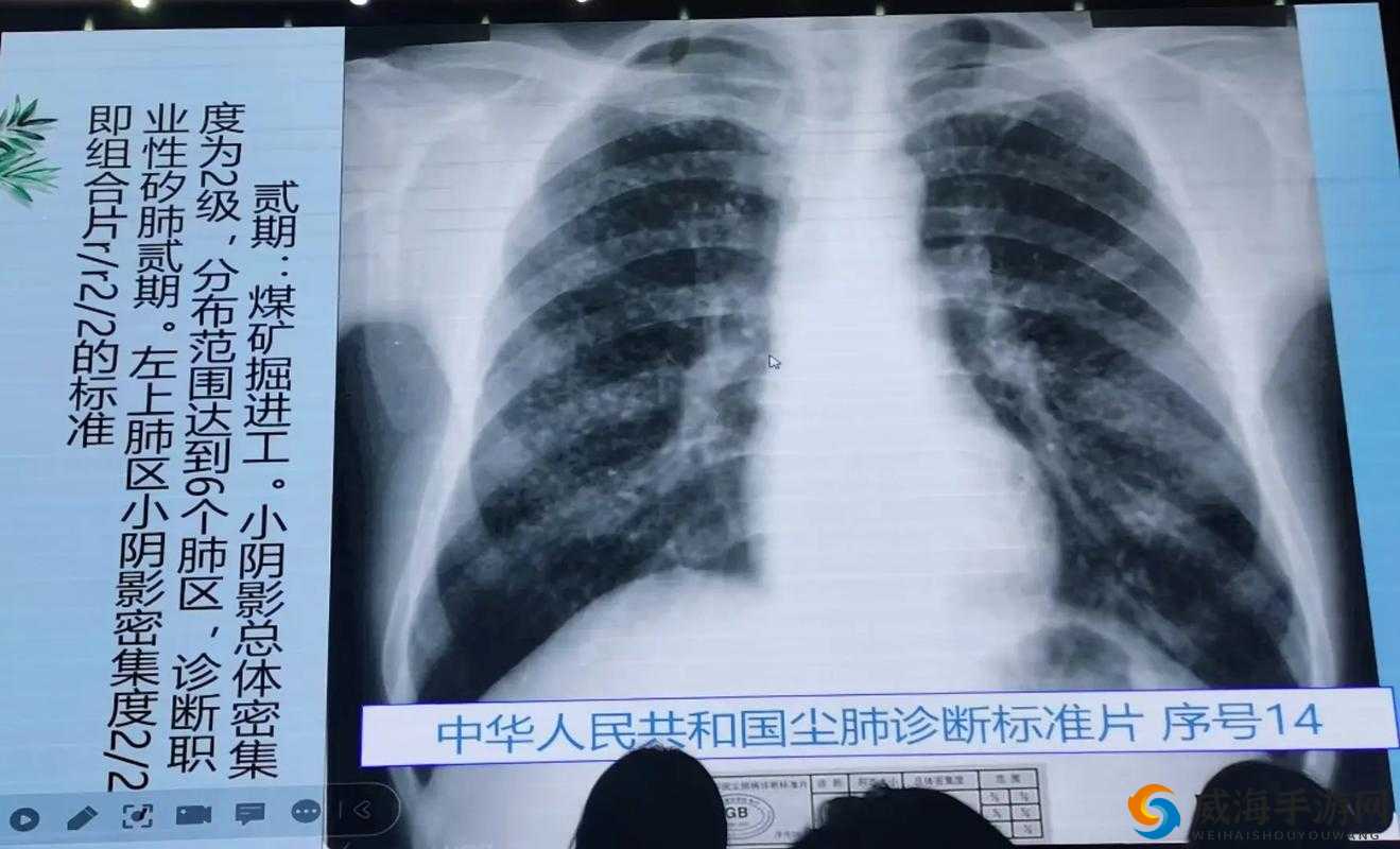 100%胸片曝光率 2023:医学影像技术的新突破