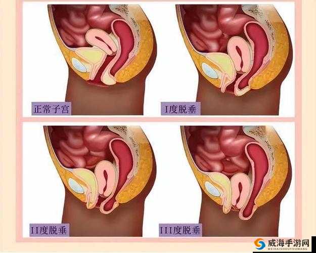 女性阴挺病是怎么回事：深入了解这种常见妇科疾病